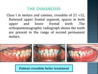 Class I in molars and canines, crossbite of 21 +12,
flattened upper frontal segment, spaces in both
upper and lower frontal teeth .The
orthopantomographic radiograph shows the teeth
are present in the range of second permanent
molars.
Patient crossbite befor treatment
 