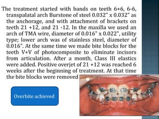 The treatment started with bands on teeth 6+6, 6-6,
transpalatal arch Burstone of steel 0.032" x 0.032" as
the anchorage, and with attachment of brackets on
teeth 21 +12, and 21 -12. In the maxilla we used an
arch of TMA wire, diameter of 0.016" x 0.022", utility
type; lower arch was of stainless steel, diameter of
0.016". At the same time we made bite blocks for the
teeth V+V of photocomposite to eliminate incisors
from articulation. After a month, Class III elastics
were added. Positive overjet of 21 +12 was reached 6
weeks after the beginning of treatment. At that time
the bite blocks were removed .
Overbite achieved
 