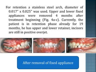 For retention a stainless steel arch, diameter of
0.017" x 0.025" was used. Upper and lower fixed
appliances were removed 4 months after
treatment beginning (Fig. 4a-c). Currently, the
patient is in retention phase already for 19
months, he has upper and lower retainer, incisors
are still in positive overjet.
After removal of fixed appliance
 