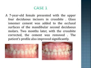 A 7-year-old female presented with the upper
four deciduous incisors in crossbite . Glass
ionomer cement was added to the occlusal
surfaces of the mandibular second deciduous
molars. Two months later, with the crossbite
corrected, the cement was removed . The
patient’s profile also improved significantly.
 