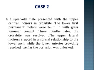 A 10-year-old male presented with the upper
central incisors in crossbite .The lower first
permanent molars were built up with glass
ionomer cement .Three months later, the
crossbite was resolved .The upper lateral
incisors erupted in a normal relationship to the
lower arch, while the lower anterior crowding
resolved itself as the occlusion was unlocked .
 