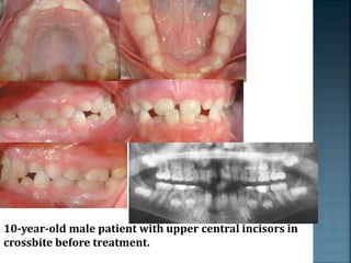 10-year-old male patient with upper central incisors in
crossbite before treatment.
 