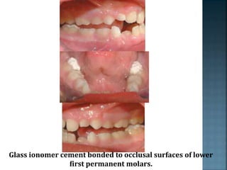 Glass ionomer cement bonded to occlusal surfaces of lower
first permanent molars.
 