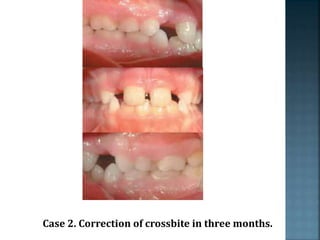 Case 2. Correction of crossbite in three months.
 