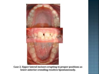 Case 2. Upper lateral incisors erupting in proper positions as
lower anterior crowding resolves Spontaneously.
 