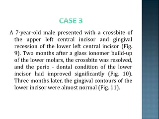 A 7-year-old male presented with a crossbite of
the upper left central incisor and gingival
recession of the lower left central incisor (Fig.
9). Two months after a glass ionomer build-up
of the lower molars, the crossbite was resolved,
and the perio - dontal condition of the lower
incisor had improved significantly (Fig. 10).
Three months later, the gingival contours of the
lower incisor were almost normal (Fig. 11).
 