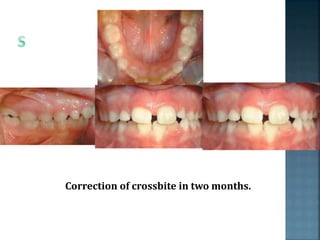 Correction of crossbite in two months.
 