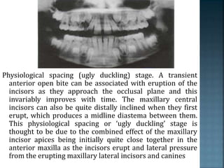 Physiological spacing (ugly duckling) stage. A transient
anterior open bite can be associated with eruption of the
incisors as they approach the occlusal plane and this
invariably improves with time. The maxillary central
incisors can also be quite distally inclined when they first
erupt, which produces a midline diastema between them.
This physiological spacing or ‘ugly duckling’ stage is
thought to be due to the combined effect of the maxillary
incisor apices being initially quite close together in the
anterior maxilla as the incisors erupt and lateral pressure
from the erupting maxillary lateral incisors and canines
 