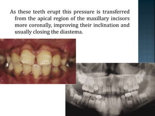 As these teeth erupt this pressure is transferred
from the apical region of the maxillary incisors
more coronally, improving their inclination and
usually closing the diastema.
 