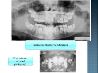 Pretreatment panorex radiogragh
Pretreatment
intraoral
photogragh
 