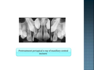 Pretreatment periapical x-ray of maxillary central
incisors
 
