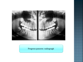 Progress panorex radiogragh
 