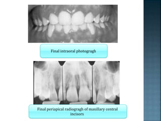 Final intraoral photogragh
Final periapical radiogragh of maxillary central
incisors
 
