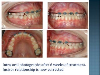 Intra-oral photographs after 6 weeks of treatment.
Incisor relationship is now corrected
 