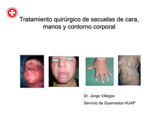 Tratamiento quirúrgico de secuelas de cara, manos y contorno corporal Dr. Jorge Villegas Servicio de Quemados HUAP 