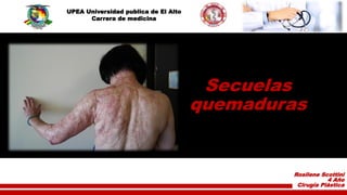 Secuelas
quemaduras
Rosilene Scottini
4 Año
Cirugía Plástica
UPEA Universidad publica de El Alto
Carrera de medicina
 