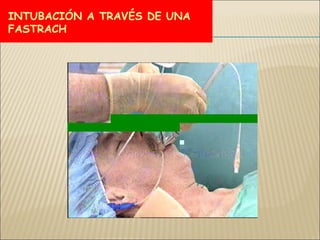 SECUENCIA DE INTUBACION RAPIDA | PPT
