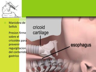Maniobra de SellickPresion firme sobre el cricoides para prevenir regurgitacion del contenido gastrico