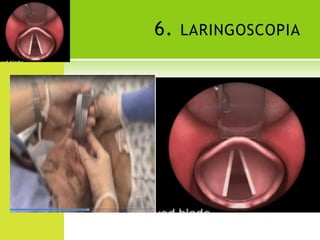 6. laringoscopia