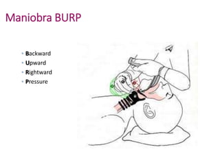 Secuencia rapida de intubacion | PPT