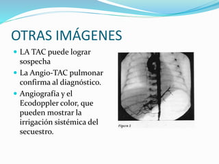 OTRAS IMÁGENES
 LA TAC puede lograr
sospecha
 La Angio-TAC pulmonar
confirma al diagnóstico.
 Angiografía y el
Ecodoppler color, que
pueden mostrar la
irrigación sistémica del
secuestro.
 