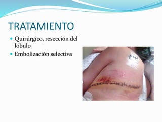 TRATAMIENTO
 Quirúrgico, resección del
lóbulo
 Embolización selectiva
 