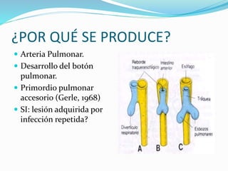 ¿POR QUÉ SE PRODUCE?
 Arteria Pulmonar.
 Desarrollo del botón
pulmonar.
 Primordio pulmonar
accesorio (Gerle, 1968)
 SI: lesión adquirida por
infección repetida?
 