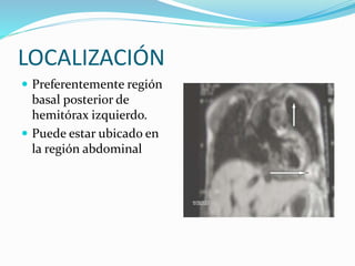 LOCALIZACIÓN
 Preferentemente región
basal posterior de
hemitórax izquierdo.
 Puede estar ubicado en
la región abdominal
 