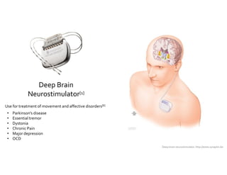 Deep Brain 
Neurostimulator[1] 
Deep brain neurostimulator. http://www.synaptix.be 
Use for treatment of movement and affective disorders[6] 
• Parkinson’s disease 
• Essential tremor 
• Dystonia 
• Chronic Pain 
• Major depression 
• OCD 
 