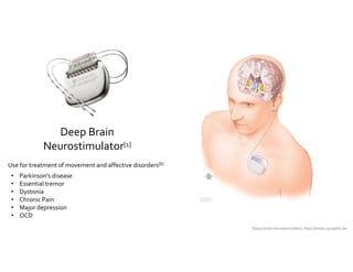 Deep Brain 
Neurostimulator[1] 
Deep brain neurostimulator. http://www.synaptix.be 
Use for treatment of movement and affe...