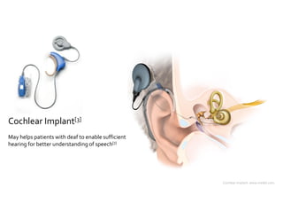 Cochlear Implant[3] 
Cochlear implant. www.medel.com. 
May helps patients with deaf to enable sufficient 
hearing for bett...