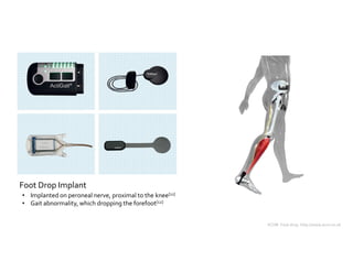 ACNR. Foot drop. http://www.acnr.co.uk 
Foot Drop Implant 
• Implanted on peroneal nerve, proximal to the knee[11] 
• Gait...