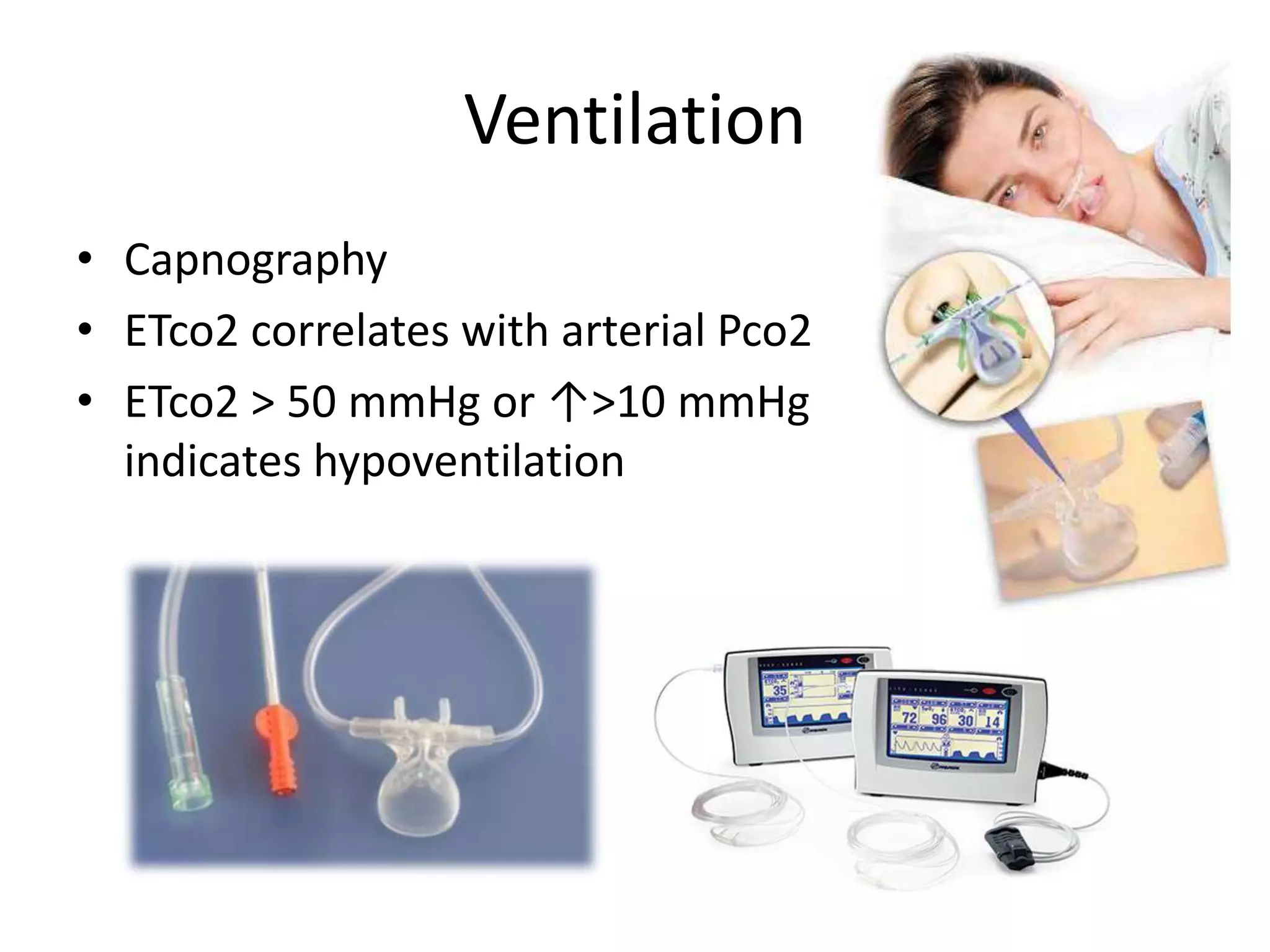 Ventilation 
• Capnography 
• ETco2 correlates with arterial Pco2 
• ETco2 > 50 mmHg or ↑>10 mmHg 
indicates hypoventilation 
 