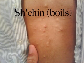 Sh'chin (boils)
 