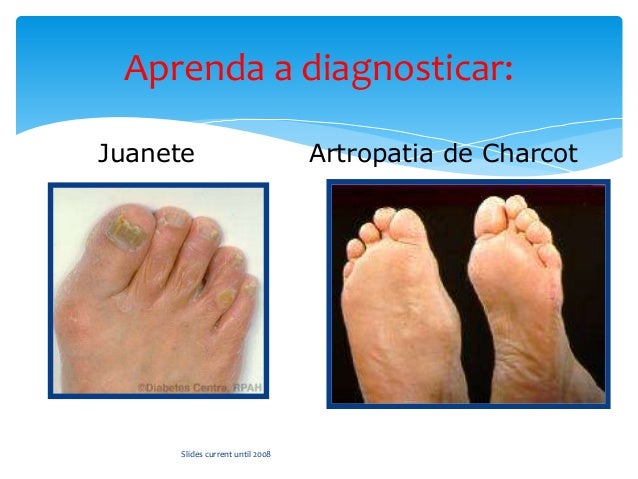 Si ayuda la celidonia mayor del hongo en los pies