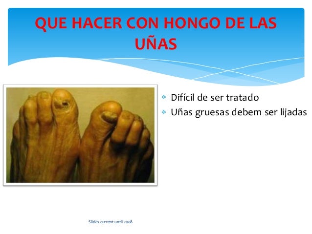 Duele el pulgar en el pie bajo la uña como curar