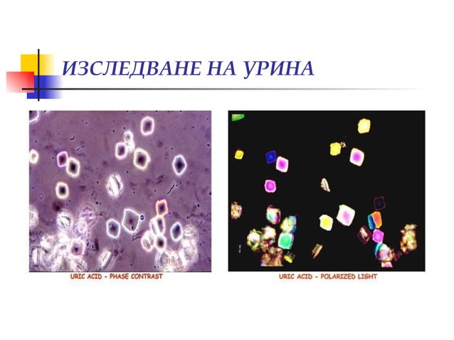Изследване на урина, уринен седимент, хематурия (диагностични аспекти ...