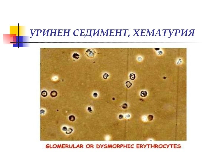 Изследване на урина, уринен седимент, хематурия (диагностични аспекти)
