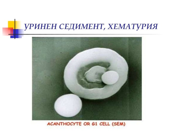 Изследване на урина, уринен седимент, хематурия (диагностични аспекти)