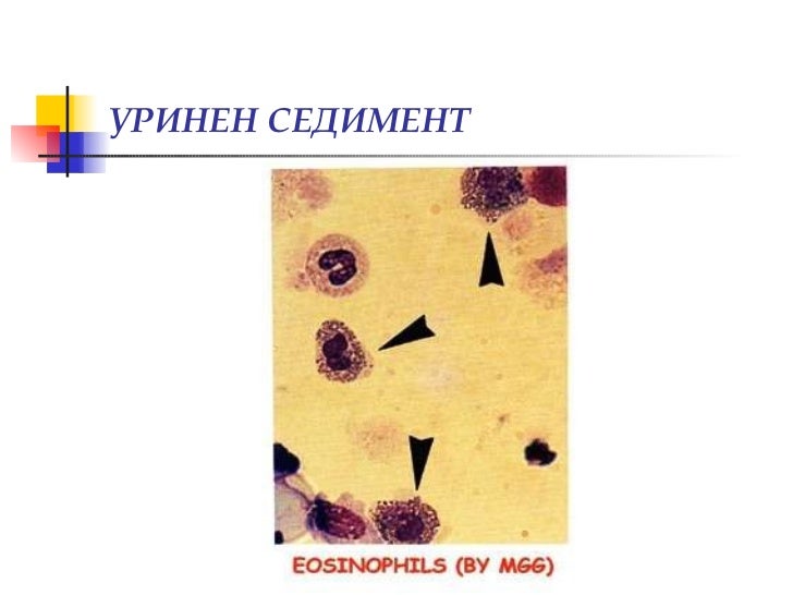 Изследване на урина, уринен седимент, хематурия (диагностични аспекти)