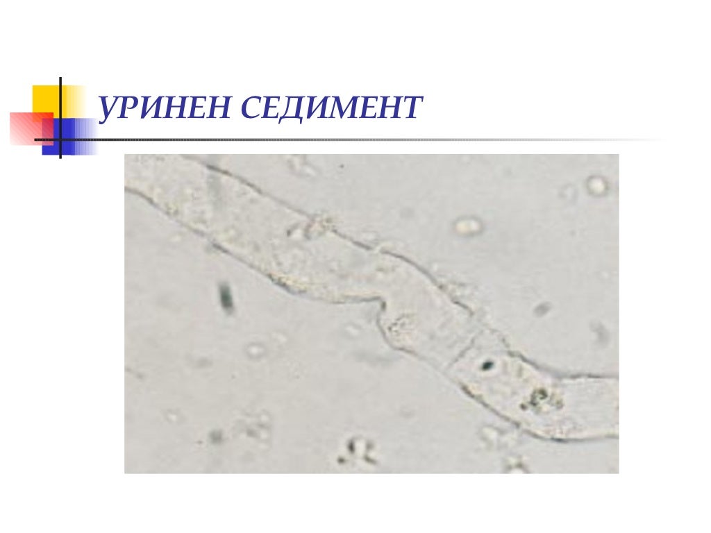 Изследване на урина, уринен седимент, хематурия (диагностични аспекти)