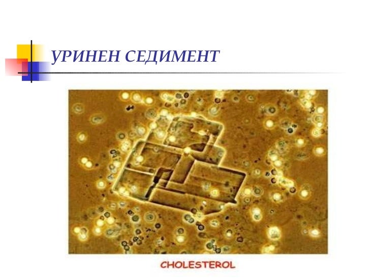Изследване на урина, уринен седимент, хематурия (диагностични аспекти)