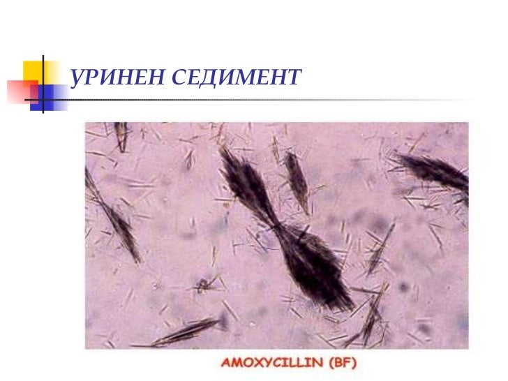 Изследване на урина, уринен седимент, хематурия (диагностични аспекти)