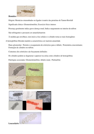 Hemático

   Origem: Hemácias emaranhadas ou ligadas à matriz das proteínas de Tamm-Horsfall

   Significado clinico: Glomerulonefrite, Exercício físico intenso

   Presença geralmente indica grave doença renal, Indica sangramento no interior do néfron

   São refringentes e possuem cor amarela/marrom

   À medida que envelhece, tem inicio a lise celular e o cilindro torna-se mais homogêneo

A hemoglobina liberada mantém a característica cor marrom-amarelada

   Dano glomerular: Permite o escapamento de eritrócitos para o túbulo; Proteinúria concomitante;
   Formação de cilindros no néfron.

   Contornos dos eritrócitos são fracamente definidos

   Os cilindros podem se degenerar e aparecer na urina como cilindros de hemoglobina

   Patologias associadas: Glomerulonefrites, Infarto renal, Pielonefrite




   Leucocitário
 