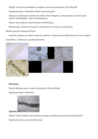 Origem: Leucócitos emaranhados ou ligadas à matriz das proteínas de Tamm-Horsfall

   Significado clinico: Pielonefrite, Nefrite intersticial aguda

   Infecção ou inflamação no interior dos néfrons. São refringentes, contem grânulos e podem conter
   núcleos multilobulados ( antes da desintegração).

   Indica a necessidade de realizar culturas microbiologicas

   Diferenciação: cilindros de bactérias (contém bacilos revestidos com anticorpos)

Identificação pela coloração de Gram

   Leucócitos chegam aos túbulos a partir do interstício, refletem doença tubulointersticial com exsudatos

neutrofílicos e inflamação, causando pielonefrite.




   Bacterianos

   Origem: Bactérias presas à matriz da proteína de Tamm-Horsfall

   Significado clinico: Pielonefrite




   Epiteliais

   Origem: Células tubulares que permanecem ligadas às fibrilas da proteína de Tamm-Horsfall

   Significado clinico: Lesão de túbulo renal
 