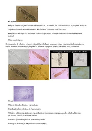 Granular

   Origem: Desintegração de cilindros leucocitários, Lisossomos das células tubulares, Agregados protéicos

   Significado clinico: Glomerulonefrite, Pielonefrite, Estresse e exercício físico.

   Origem não-patológica: Lisossomos excretados pelas cels. dos túbulos renais durante metabolismo
   normal

   Origem patológica:

Desintegração de cilindros celulares e de células tubulares, necessário estase e que os cilindros estejam no
túbulo para que sua desintegração produza grânulos.Agregados protéicos filtrados pelo glomérulos




   Céreo

   Origem: Cilindros hialinos e granulares

   Significado clinico: Estase do fluxo urinário

   Cilindros refringentes de textura rígida: Por isso fragmentam-se ao passar pelos túbulos, São mais
   facilmente visualizados que os hialinos.

   Estrutura: placas rompidas de proteína superficial

   Patologias: Inflamação, Degeneração tubular ( IRC)
 