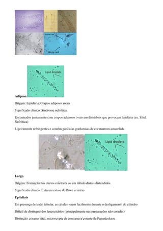Adiposo

Origem: Lipidúria, Corpos adiposos ovais

Significado clinico: Síndrome nefrótica.

Encontrados juntamente com corpos adiposos ovais em distúrbios que provocam lipidúria (ex. Sínd.
Nefrótica)

Ligeiramente refringentes e contém gotículas gordurosas de cor marrom-amarelada




Largo

Origem: Formação nos ductos coletores ou em túbulo distais distendidos

Significado clinico: Extrema estase do fluxo urinário

Epiteliais

Em presença de lesão tubular, as células saem facilmente durante o desligamento do cilindro

Difícil de distinguir dos leucocitários (principalmente nas preparações não coradas)

Distinção: corante vital, microscopia de contraste e corante de Papanicolaou
 