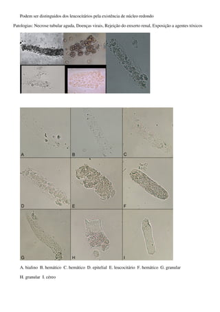 Podem ser distinguidos dos leucocitários pela existência de núcleo redondo

Patologias: Necrose tubular aguda, Doenças virais, Rejeição do enxerto renal, Exposição a agentes tóxicos




   A. hialino B. hemático C. hemático D. epitelial E. leucocitário F. hemático G. granular

   H. granular I. céreo
 