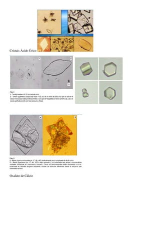 Cristais Ácido Úrico




Oxalato de Cálcio
 