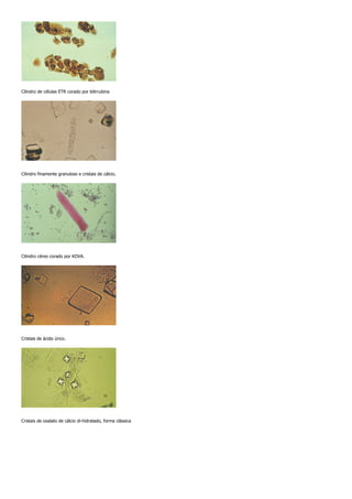 Cilindro de células ETR corado por bilirrubina




Cilindro finamente granuloso e cristais de cálcio.




Cilindro céreo corado por KOVA.




Cristais de ácido úrico.




Cristais de oxalato de cálcio di-hidratado, forma clássica
 